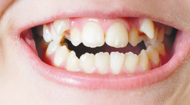 5 Tooth Shape Differences That May Need Pediatric Dental Monitoring
